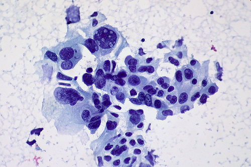 cancer cell Lung Carcinoma