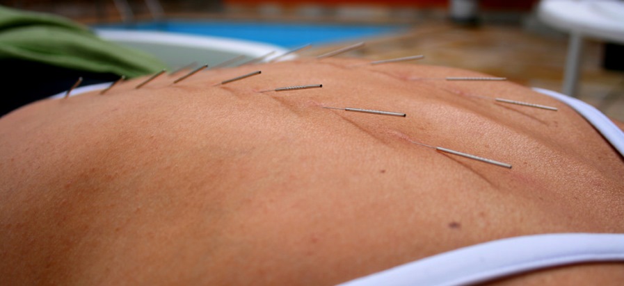 Acupuncture is safe and painless, with a long history of effectively treating disease. A close-up of a woman getting acupuncture poolside.